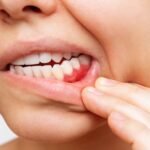 How Lymphatic Drainage Can Reverse Gum Disease 1708442893_Jodi-1-1.jpg